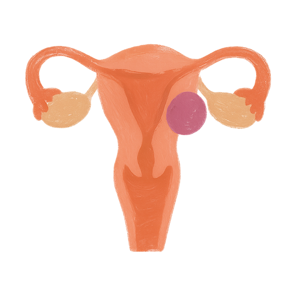 Illustration of the female reproductive system highlighting a uterine fibroid, representing fibroids that affect fertility.